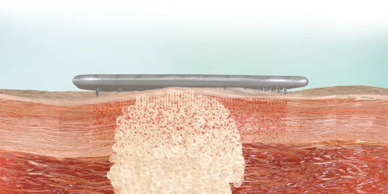 How SkinJect’s Microneedle-Patch Could Improve Skin Cancer Treatment Outcomes